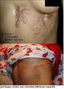 Before After Pictures,Delhitissue expansion, scar removal 